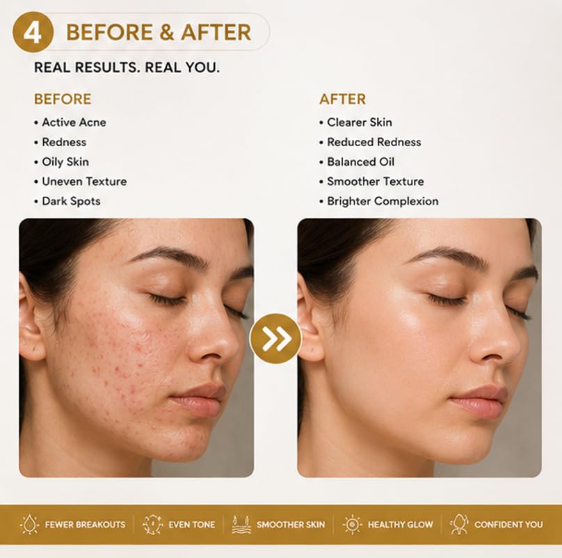 Glory Kit Anti Acne Skin Care Serum with Non Greasy Formula for Everyday Facial Care Routine and Comfortable Wear, 30 ml